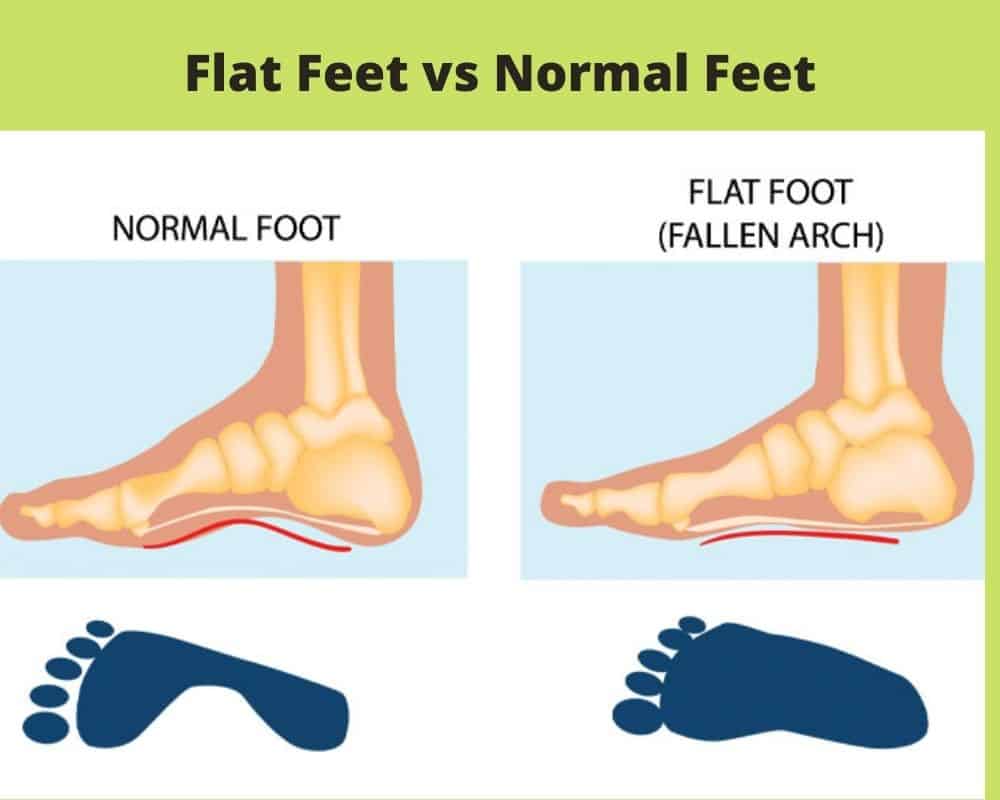 Flat Feet Vs Normal Feet